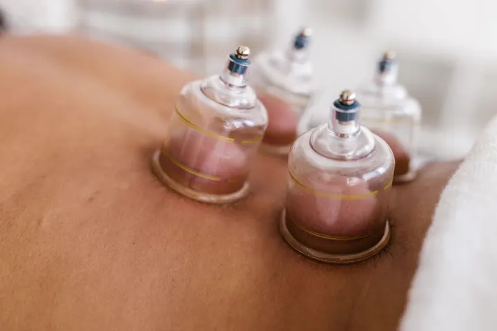 Dry cupping cups on the back